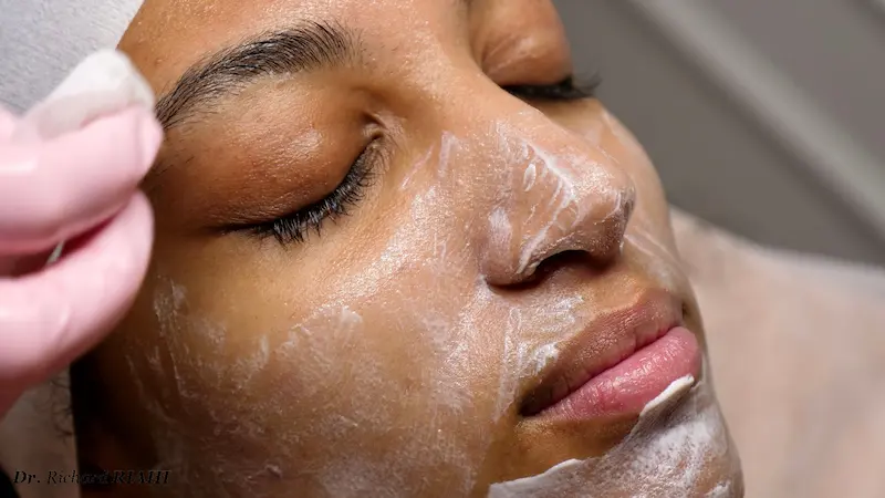 Peeling profond au phénol