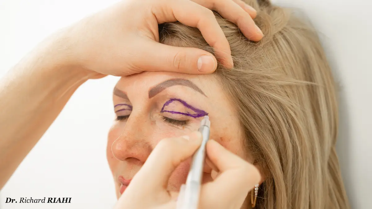 Blépharoplastie