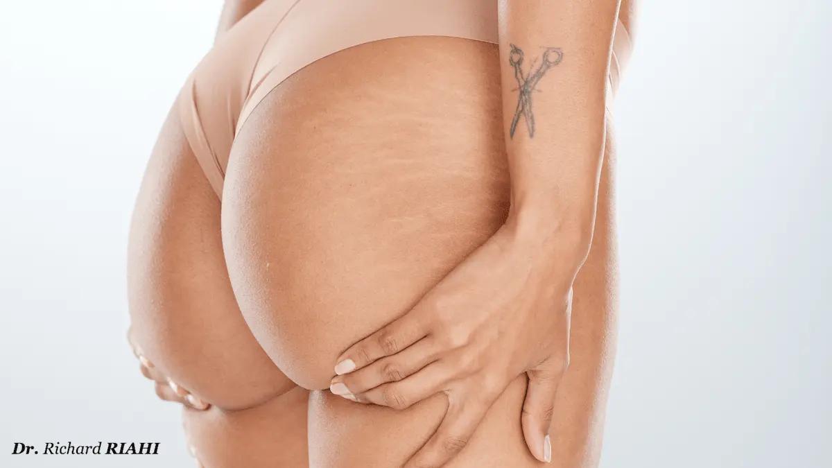 Prothèses de fesses