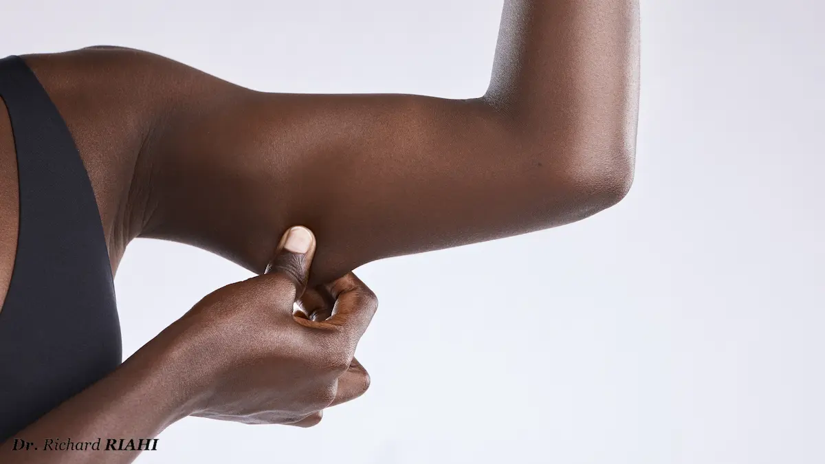 Lifting des bras