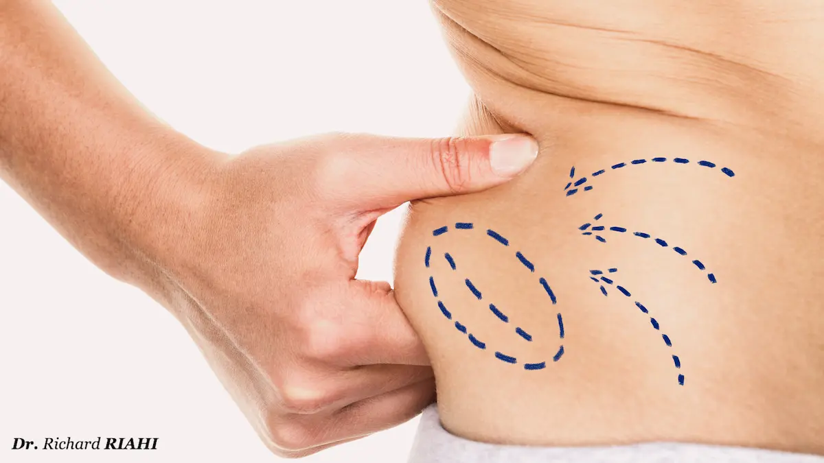 Lipoaspiration - Liposuccion